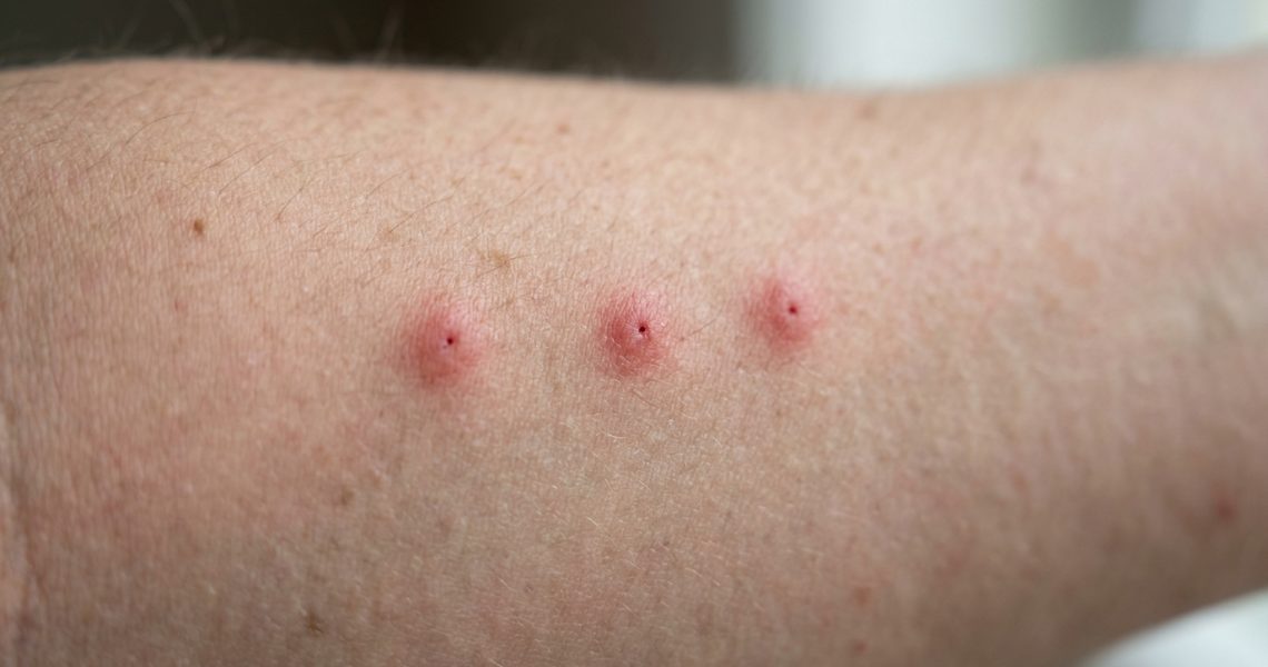Bed Bug Bites vs Mosquito Bites | How to Tell the Difference